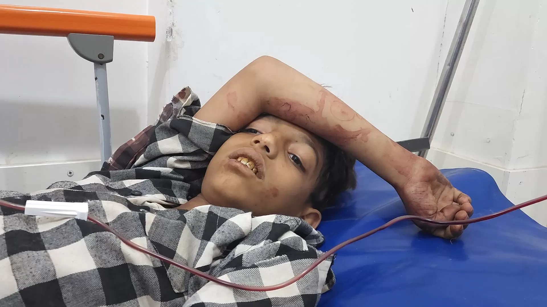 إصابة طفلين برصاص قناصة الحوثيين في الدمينة غربي تعز