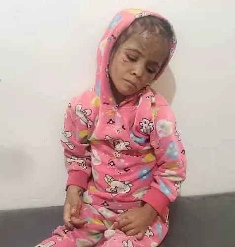 جريمة تعذيب مروعة لطفلة في إب تكشف تفشي العنف الأسري تحت سلطة الحوثيين