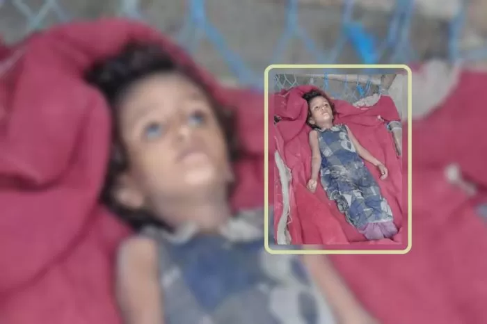 وفاة طفلة نازحة جوعًا في حجة تكشف مأساة إنسانية وسط نهب حوثي للمساعدات