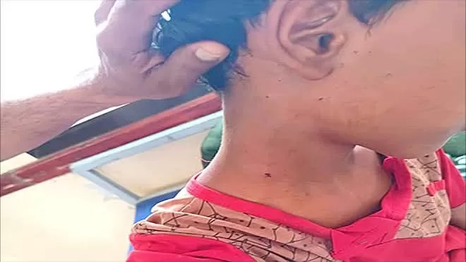 إصابة طفل برصاص قناص حوثي أثناء رعيه للأغنام شمال لحج